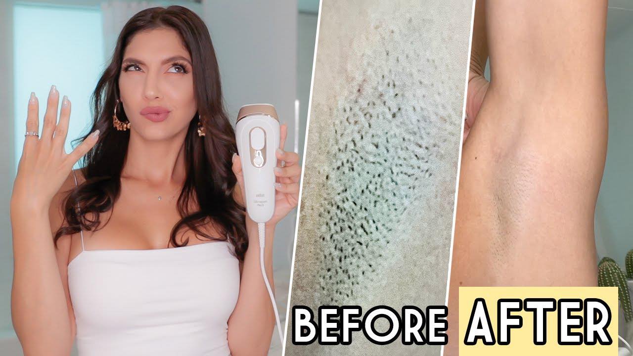 Image of a woman holding a Braun IPL and photos of before and after hair growth result of her underarm 